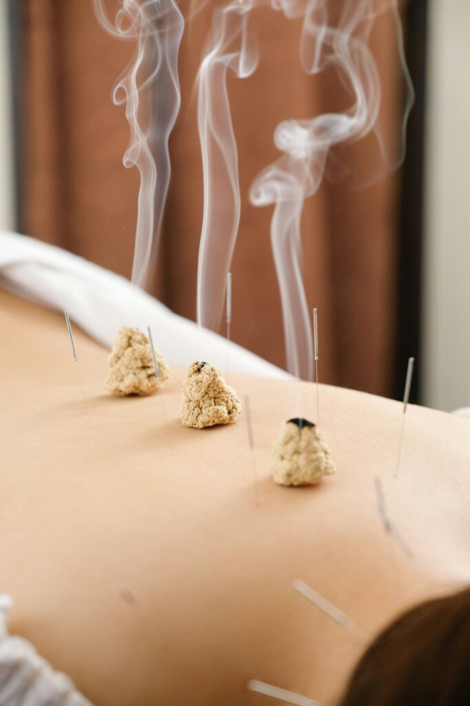 Acupuncture and moxibustion on the back of a woman in a bright acupuncture center