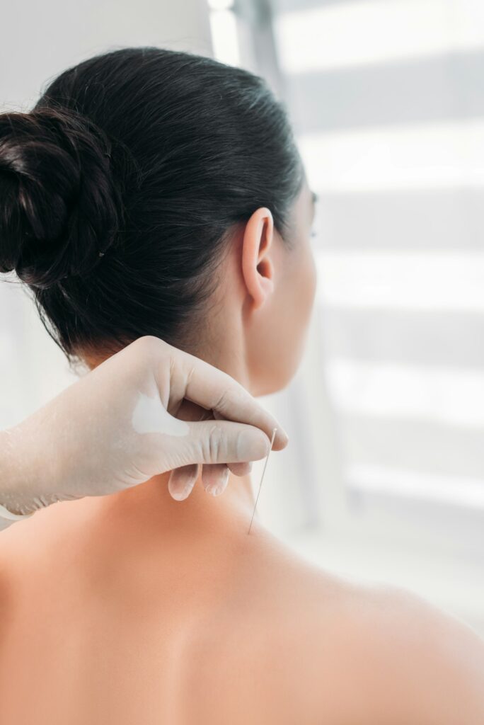 cropped shot of cosmetologist putting needles on womans body during acupuncture therapy in spa salon